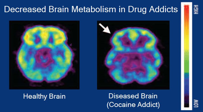 Brain metabolism and drug addiction