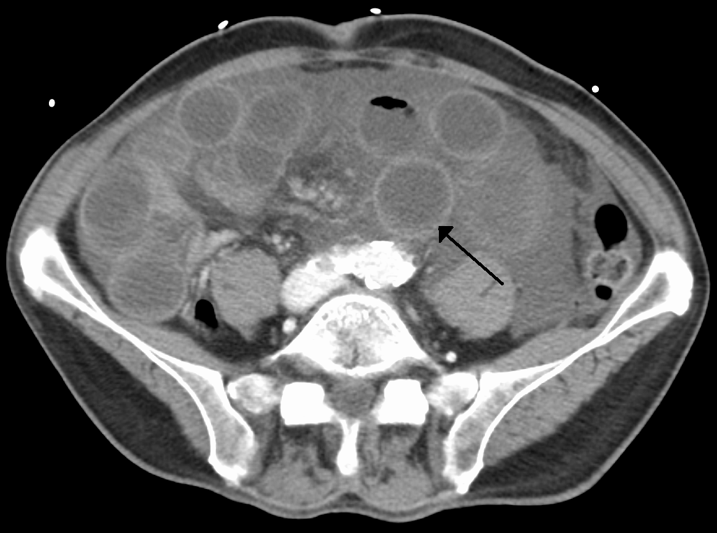 Ischemicbowel